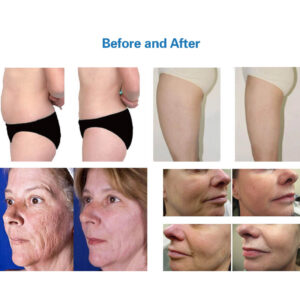 Ideal Shape - Urządzenie do modelowania sylwetki - obrazek 4